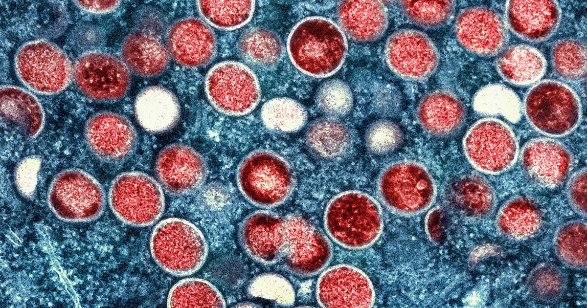 First locally acquired U.S. cases of more severe mpox strain reported