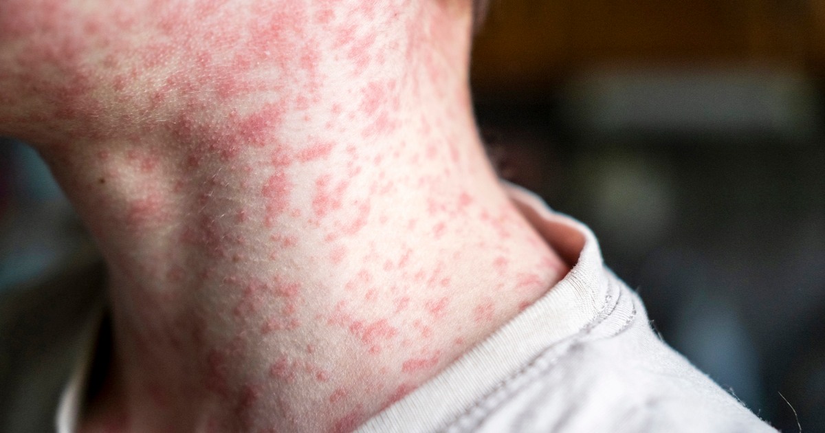 Where is measles spreading? Here’s what to know.
