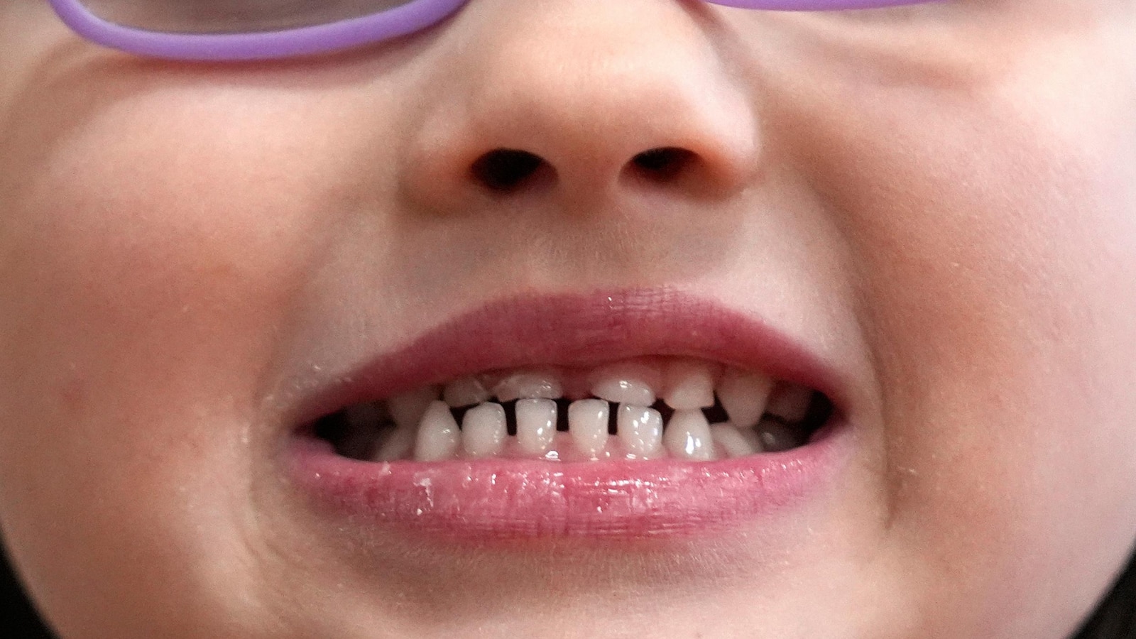FDA restricts use of kids’ fluoride supplements citing emerging health risks