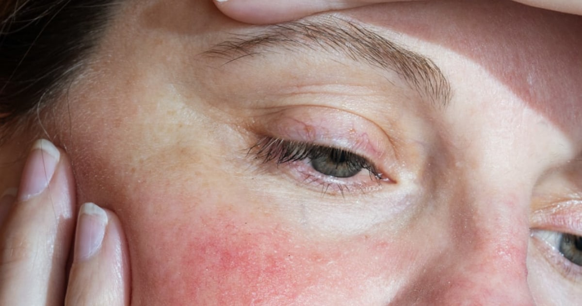 The best acne scar treatments that dermatologists say actually fade dark spots